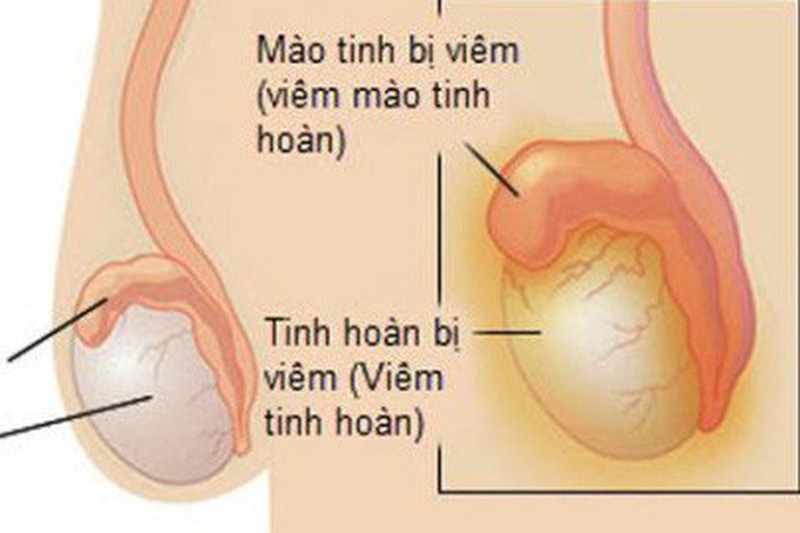 Viêm tinh hoàn - Hình ảnh minh họa